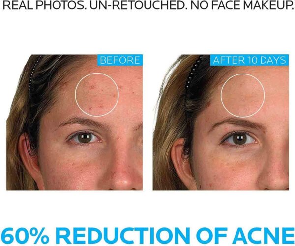 La Roche-Posay Effaclar Duo Dual Action Acne Spot Treatment Cream with Benzoyl Peroxide Acne Treatment, Blemish Cream for Acne - Image 26