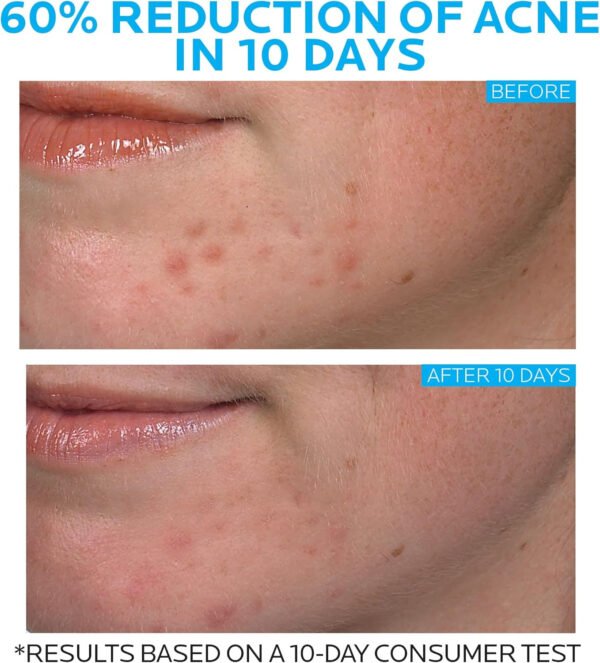 La Roche-Posay Effaclar Duo Dual Action Acne Spot Treatment Cream with Benzoyl Peroxide Acne Treatment, Blemish Cream for Acne - Image 3